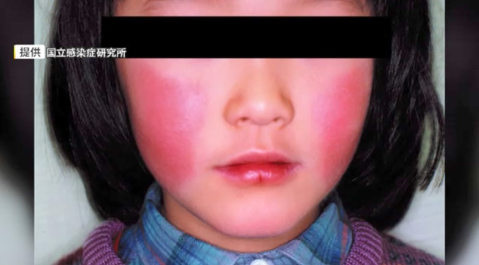 リンゴ病（伝染性紅斑）福岡県内で過去最多に　子供中心に流行し妊婦は流産リスクも　予防薬なくマスク着用や手洗い呼びかけ